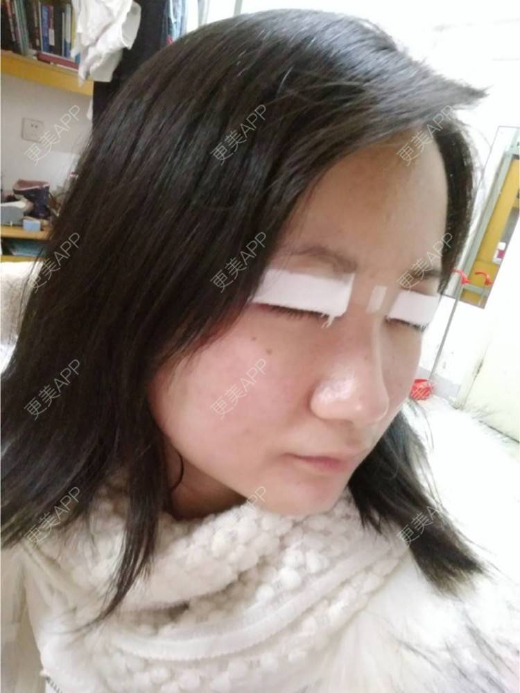 更美 - 谁叫我是水瓶座的全切双眼皮经验 | 眼部多项 | 精切双眼皮 | 全切双眼皮 | 武汉