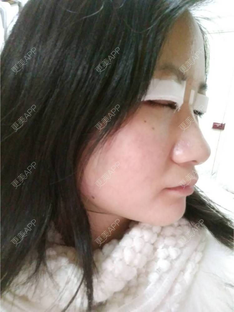 更美 - 谁叫我是水瓶座的全切双眼皮经验 | 眼部多项 | 精切双眼皮 | 全切双眼皮 | 武汉