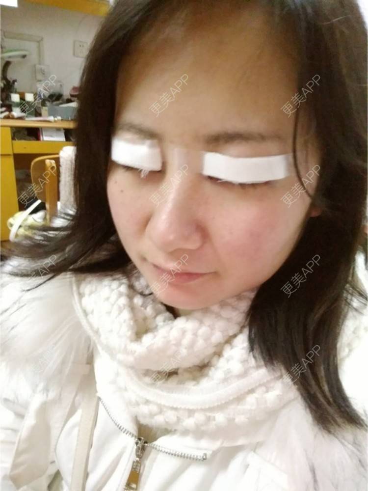 更美 - 谁叫我是水瓶座的全切双眼皮经验 | 眼部多项 | 精切双眼皮 | 全切双眼皮 | 武汉