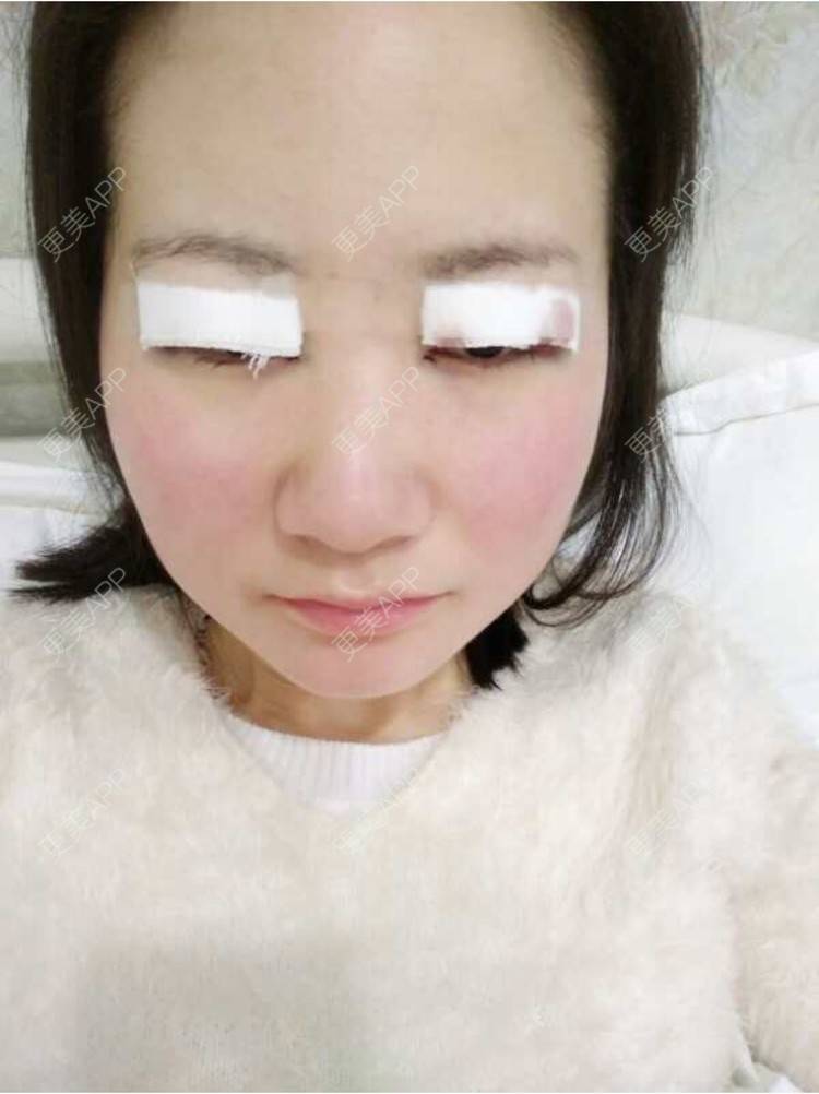 更美 - 谁叫我是水瓶座的全切双眼皮经验 | 眼部多项 | 精切双眼皮 | 全切双眼皮 | 武汉