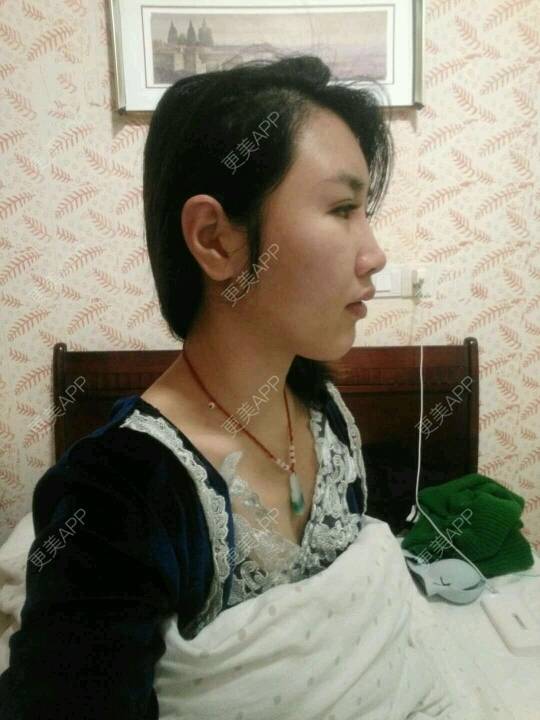 更美 - LOw3的吸脂瘦脸经验 | 吸脂瘦脸 | 南昌