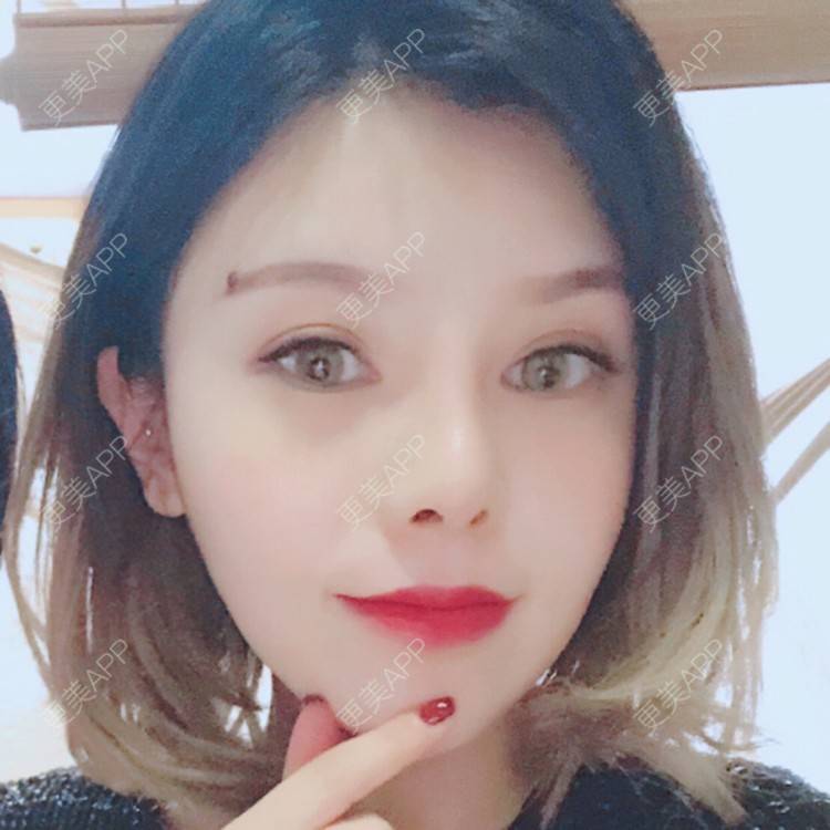 更美 - 薇一美静静💗的耳软骨隆鼻经验 | 假体鼻子下巴 | 鼻中隔软骨垫鼻头 | 合肥 | 耳软骨隆鼻