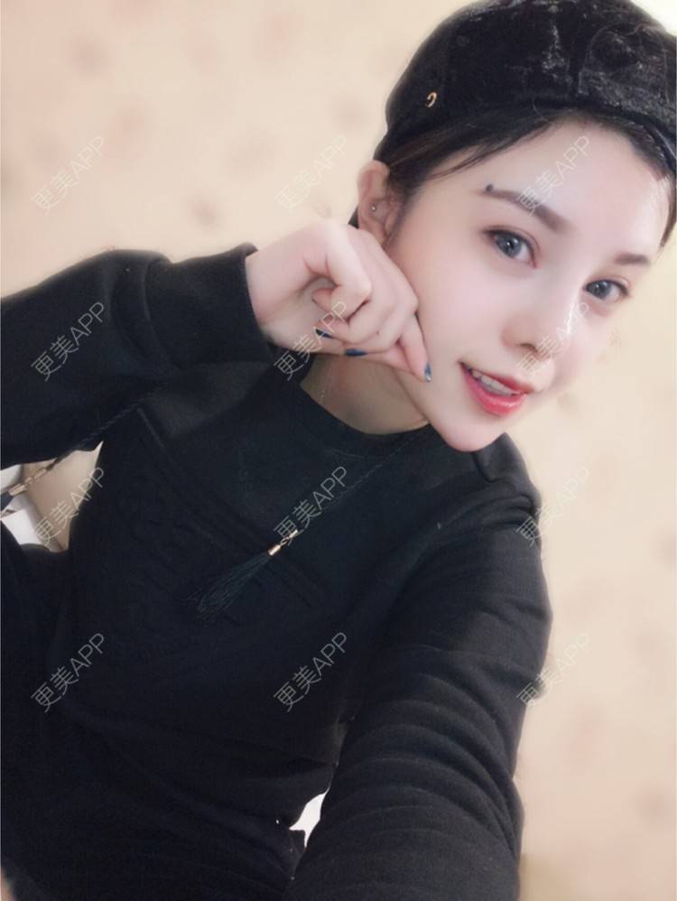 更美 - 薇一美静静💗的耳软骨隆鼻经验 | 假体鼻子下巴 | 鼻中隔软骨垫鼻头 | 合肥 | 耳软骨隆鼻