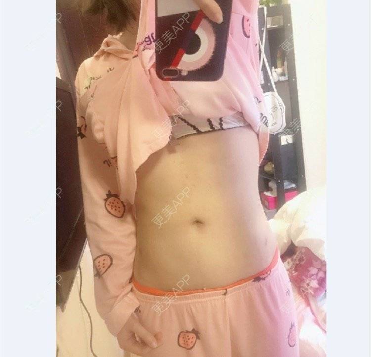 更美 - mikobb的腰腹吸脂经验 | 成都 | 腰腹吸脂