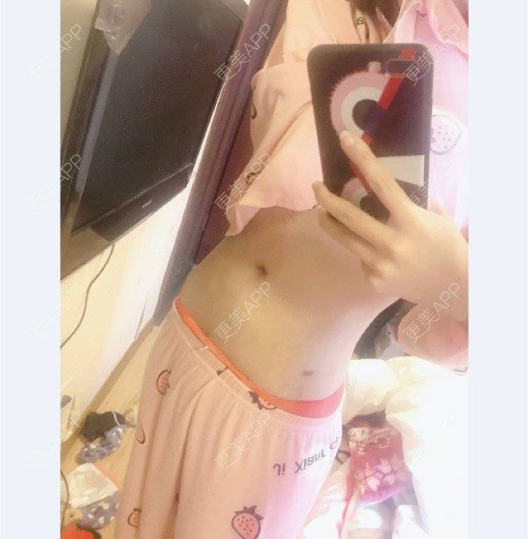 更美 - mikobb的腰腹吸脂经验 | 成都 | 腰腹吸脂