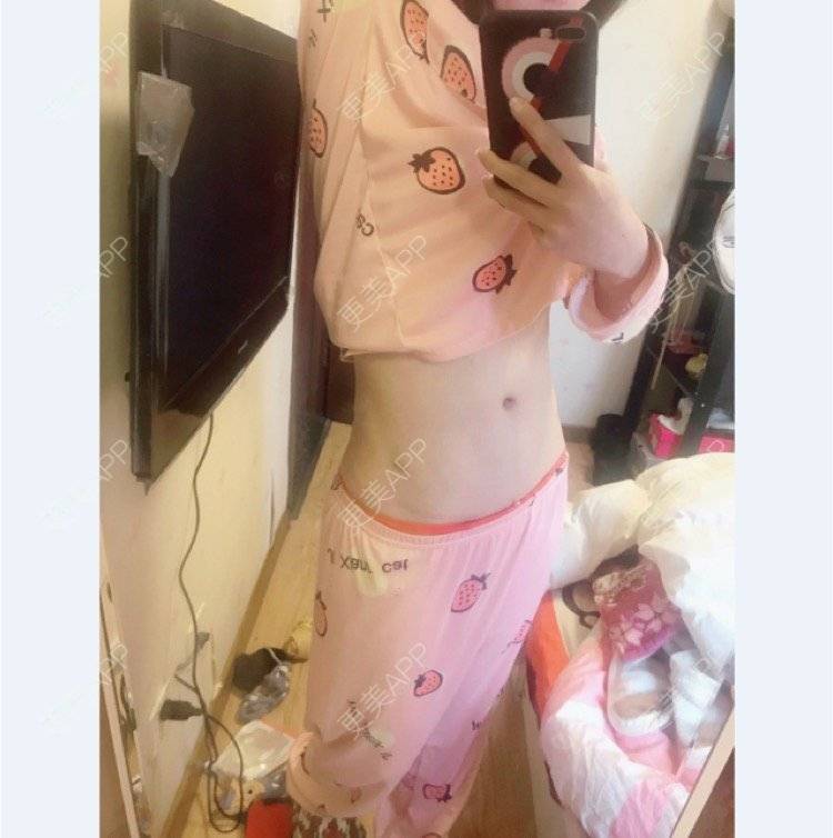 更美 - mikobb的腰腹吸脂经验 | 成都 | 腰腹吸脂
