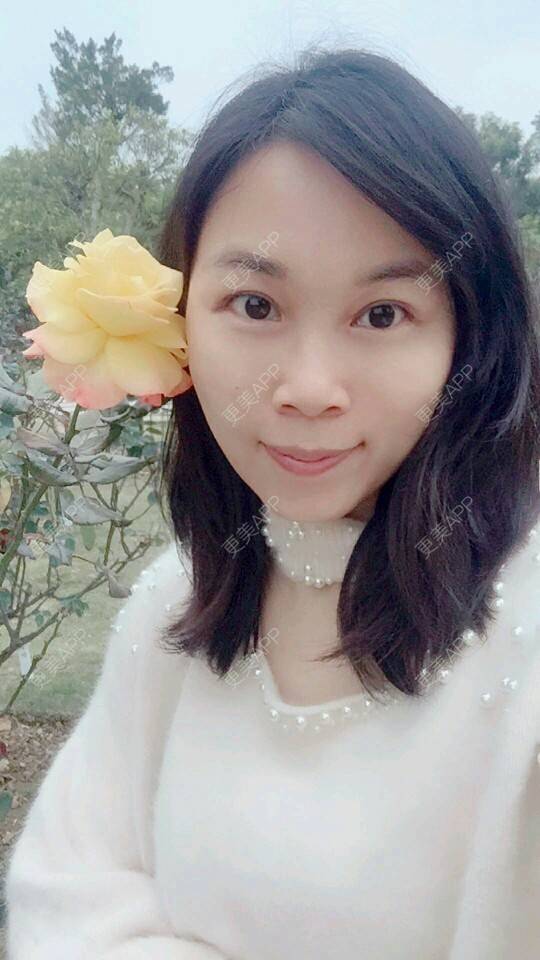 更美 - 变成美大妈的经验 | 自体脂肪面部年轻化 | 吸脂 | 武汉