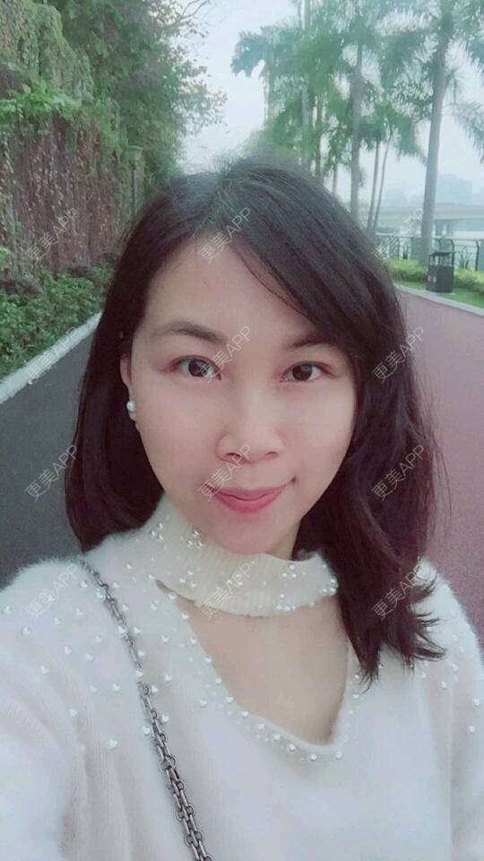 更美 - 变成美大妈的经验 | 自体脂肪面部年轻化 | 吸脂 | 武汉