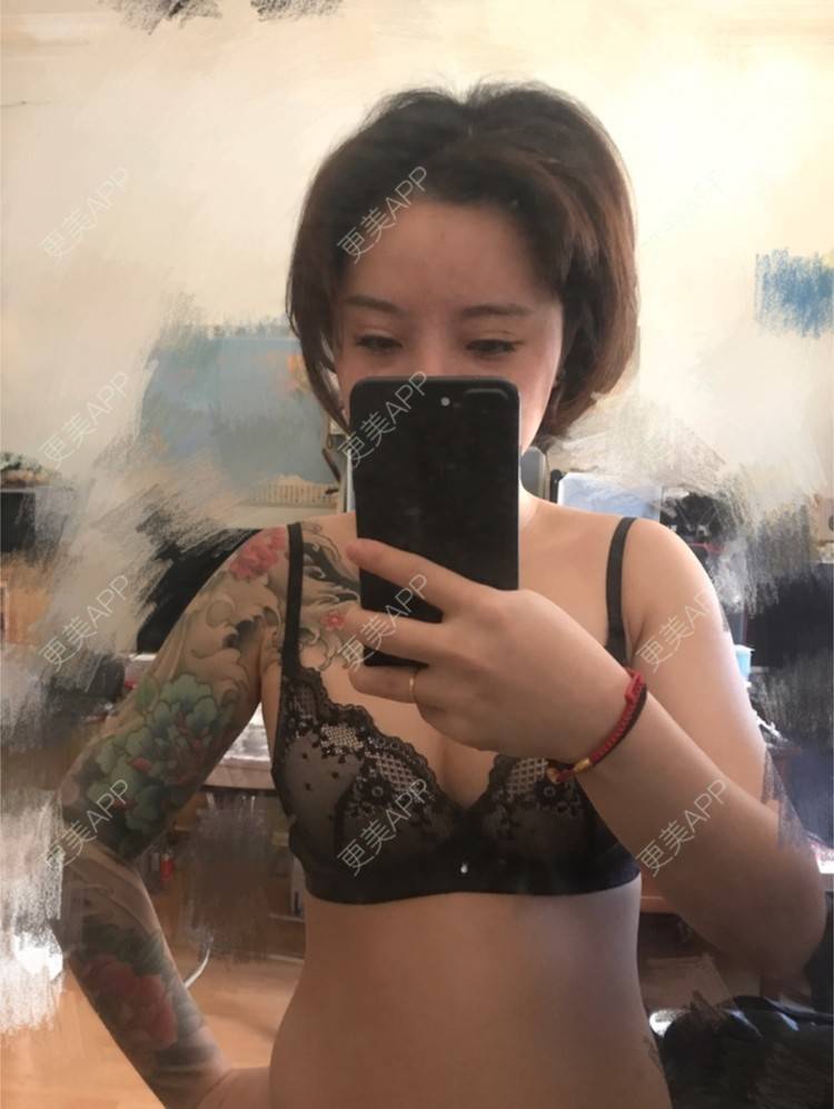 更美 - Joni小小板娘的射频溶脂瘦手臂经验 | 上海 | 视频日记 | 射频溶脂瘦手臂