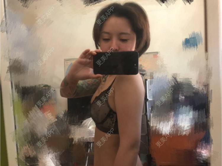 更美 - Joni小小板娘的射频溶脂瘦手臂经验 | 上海 | 视频日记 | 射频溶脂瘦手臂