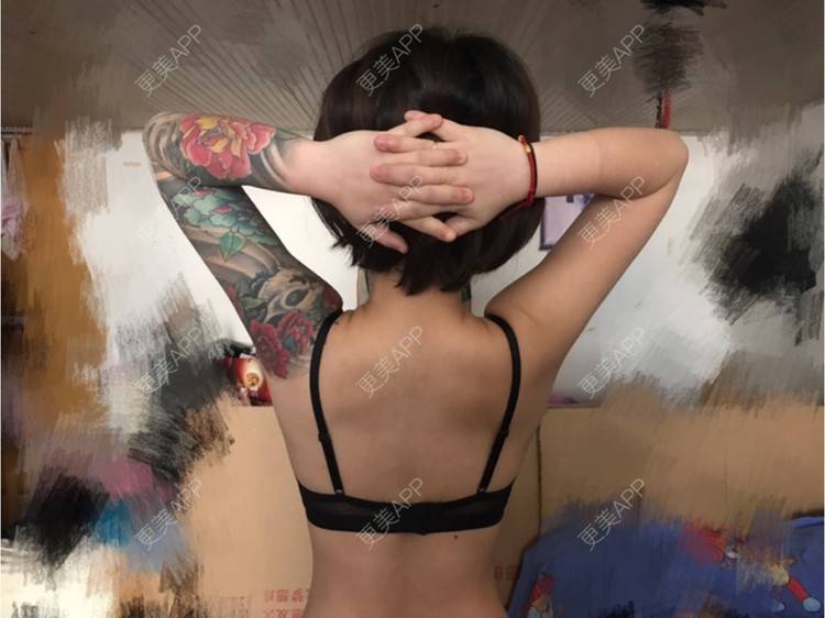 更美 - Joni小小板娘的射频溶脂瘦手臂经验 | 上海 | 视频日记 | 射频溶脂瘦手臂