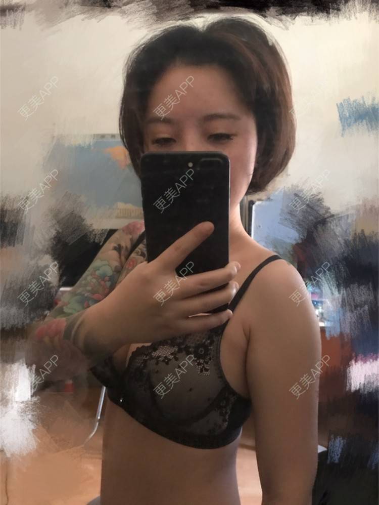 更美 - Joni小小板娘的射频溶脂瘦手臂经验 | 上海 | 视频日记 | 射频溶脂瘦手臂