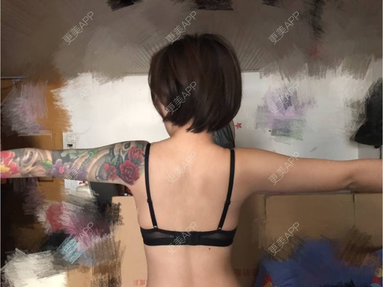 更美 - Joni小小板娘的射频溶脂瘦手臂经验 | 上海 | 视频日记 | 射频溶脂瘦手臂