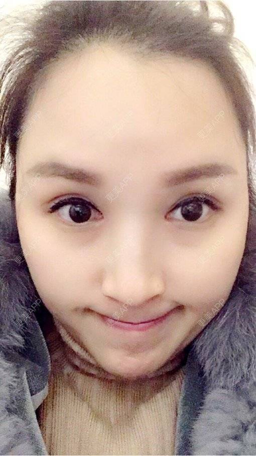 小雨儿悠悠的双眼皮修复日记