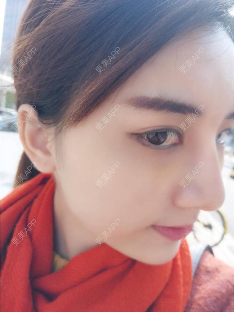 更美 - 黄金金的开外眼角经验 | 鼻骨内推 | 潮州 | 下至 | 开外眼角