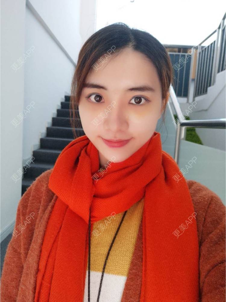 更美 - 黄金金的开外眼角经验 | 鼻骨内推 | 潮州 | 下至 | 开外眼角