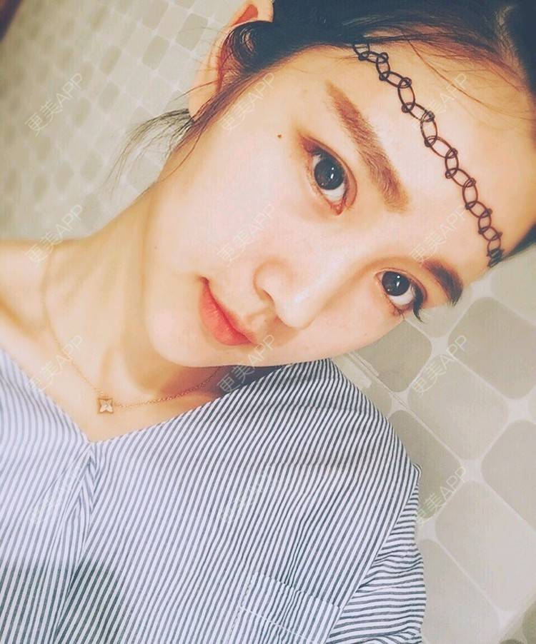 更美 - 凌萱酱的膨体垫下巴经验 | 重庆 | 膨体垫下巴