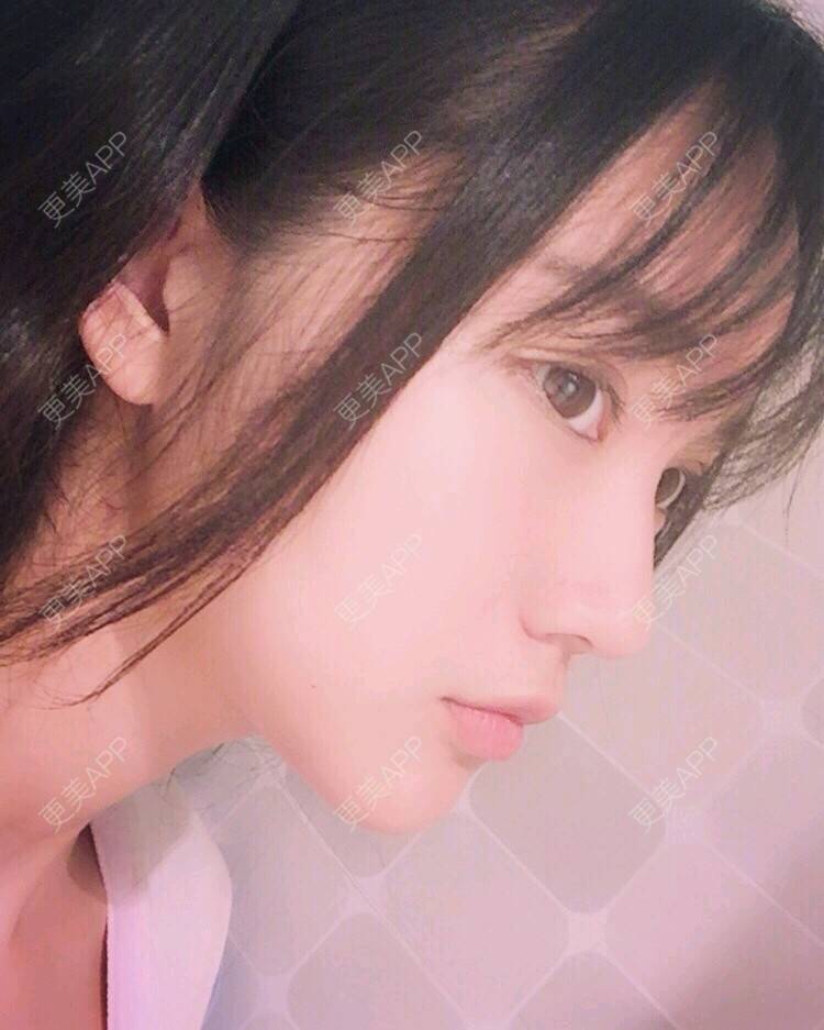 更美 - 凌萱酱的膨体垫下巴经验 | 重庆 | 膨体垫下巴