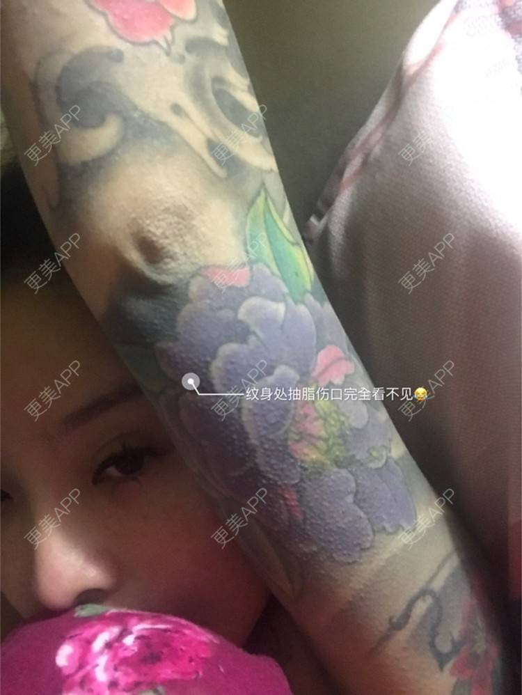更美 - Joni小小板娘的射频溶脂瘦手臂经验 | 上海 | 射频溶脂瘦手臂 | 视频日记
