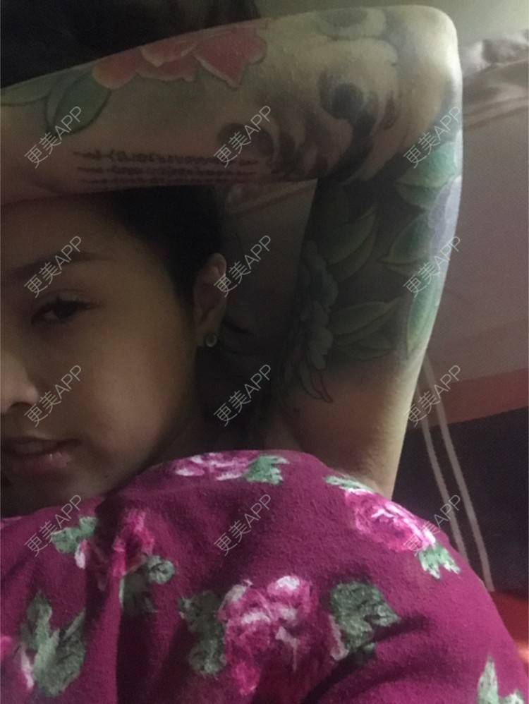 更美 - Joni小小板娘的射频溶脂瘦手臂经验 | 上海 | 射频溶脂瘦手臂 | 视频日记