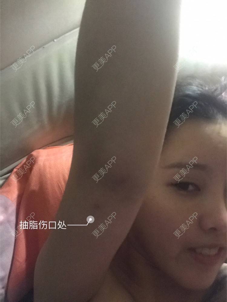 更美 - Joni小小板娘的射频溶脂瘦手臂经验 | 上海 | 射频溶脂瘦手臂 | 视频日记