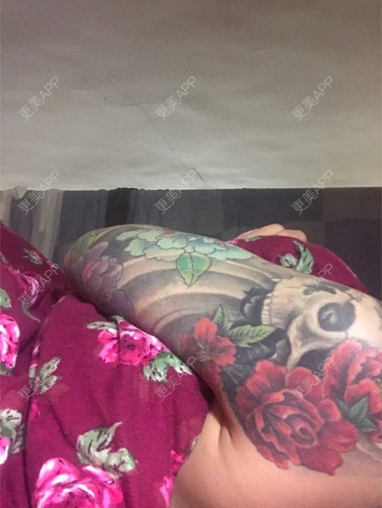更美 - Joni小小板娘的射频溶脂瘦手臂经验 | 上海 | 射频溶脂瘦手臂 | 视频日记