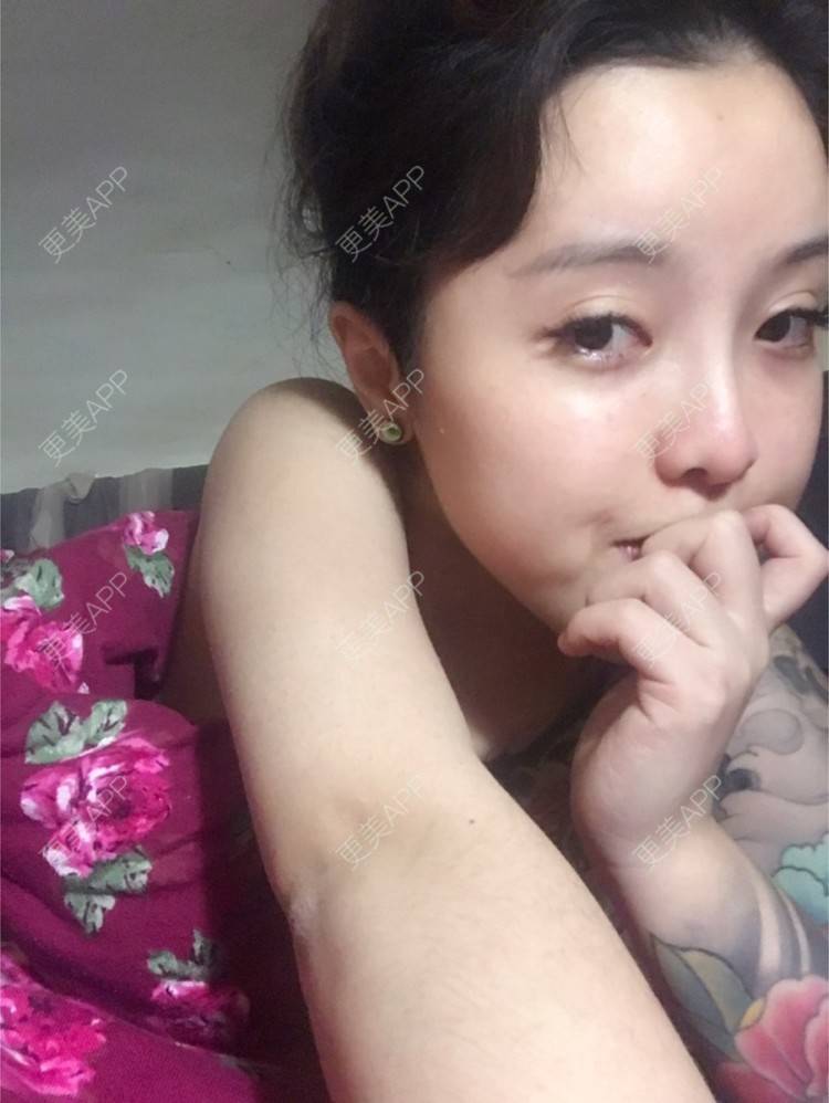 更美 - Joni小小板娘的射频溶脂瘦手臂经验 | 上海 | 射频溶脂瘦手臂 | 视频日记