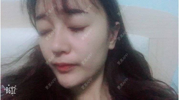 更美 - 匆匆1108的全脸整形套餐经验 | 全脸整形套餐 | 鼻部整形 | 武汉 | 隆鼻