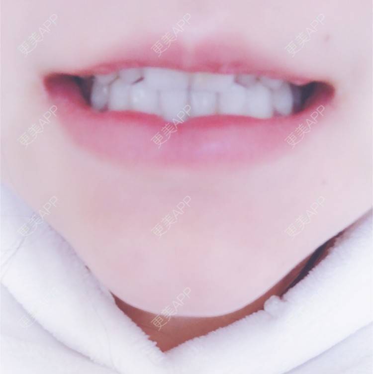 oshiete的牙齿美白日记