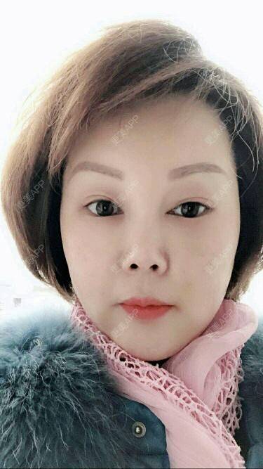更美 - Eugenec的自体脂肪丰面颊经验 | 面部轮廓 | 自体脂肪面部年轻化 | 武汉 | 自体脂肪丰面颊