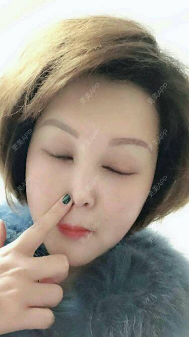 更美 - Eugenec的自体脂肪丰面颊经验 | 面部轮廓 | 自体脂肪面部年轻化 | 武汉 | 自体脂肪丰面颊