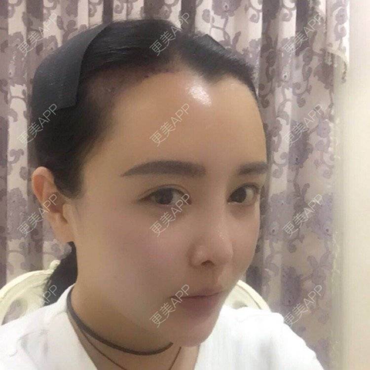 更美 - Mtwinkle的植发际线经验 | 重庆 | 女性植发 | 植发际线 | 毛发管理