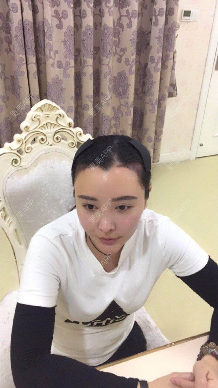 更美 - Mtwinkle的植发际线经验 | 重庆 | 女性植发 | 植发际线 | 毛发管理