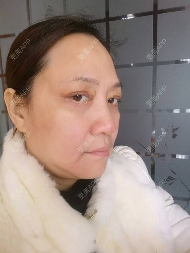 娟娟麻麻的外切去眼袋日记