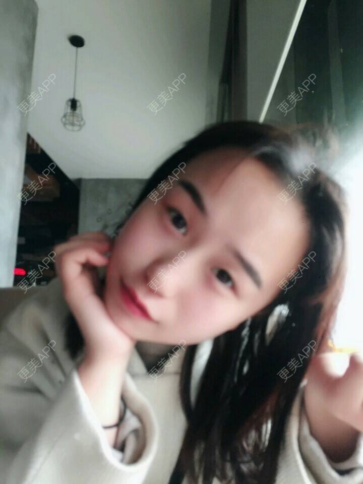 更美 - 文文阳的植发际线经验 | 成都 | 视频日记 | 植发最好的医院 | 植发际线 | 鬓角种植