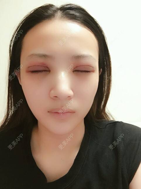 更美 - 一份流年，倆人受傷的双眼皮经验 | 双眼皮全切加开眼角 | 马永奇医生 | 双眼皮 | 北京