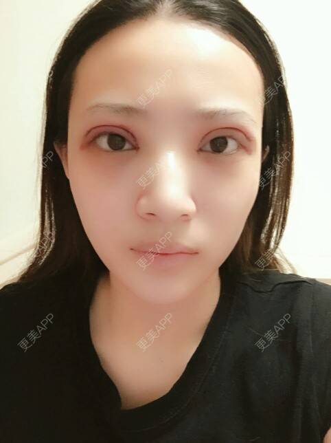 更美 - 一份流年，倆人受傷的双眼皮经验 | 双眼皮全切加开眼角 | 马永奇医生 | 双眼皮 | 北京
