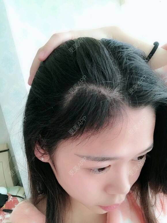 更美 - 潘潘。。的植发际线经验 | 成都 | 视频日记 | 植发际线 | 女性植发 | 鬓角种植