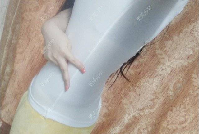 更美 - 许你个假承诺的腰腹吸脂经验 | 侧腰吸脂 | 吸脂手术 | 腰腹吸脂 | 重庆