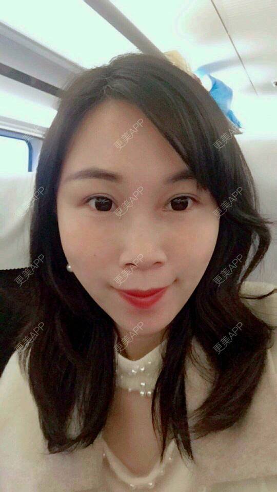 更美 - 变成美大妈的经验 | 自体脂肪面部年轻化 | 武汉