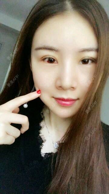 更美 - xNz3B婷的歪鼻矫正经验 | 上海 | 歪鼻矫正