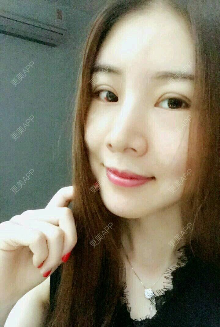 更美 - xNz3B婷的歪鼻矫正经验 | 上海 | 歪鼻矫正