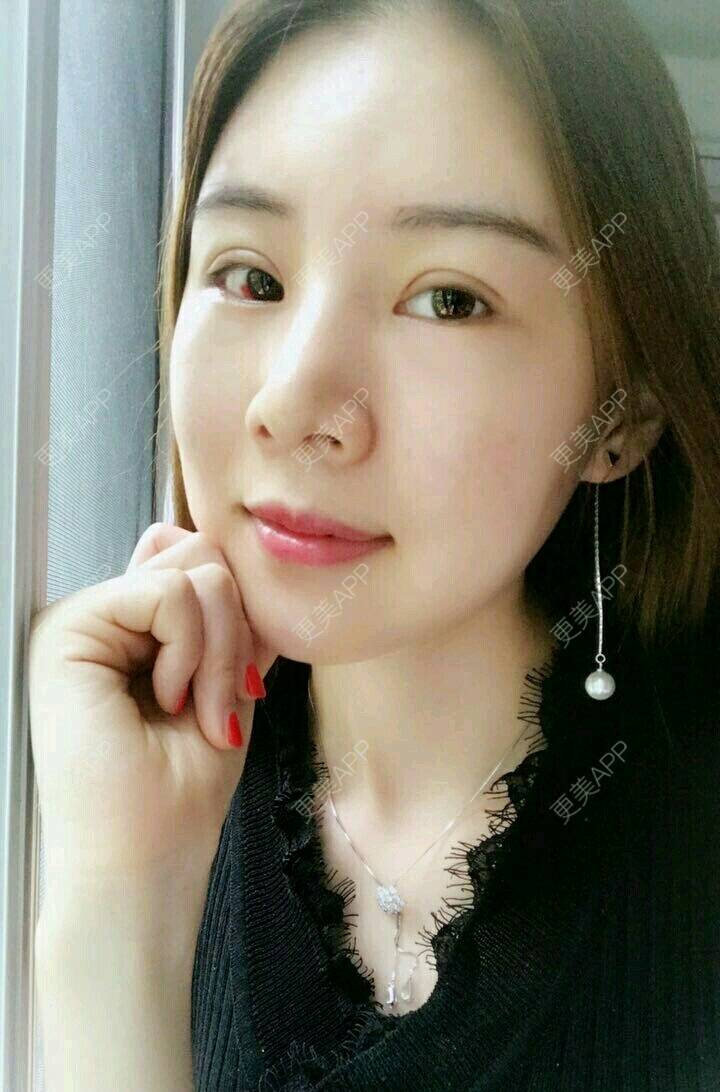 更美 - xNz3B婷的歪鼻矫正经验 | 上海 | 歪鼻矫正