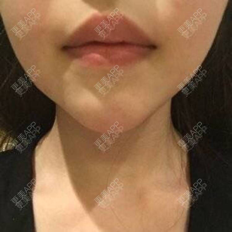 更美 - 苏苏女神的唇综合经验 | 武汉 | 激光脱毛 | 北京 | 杭州 | 唇综合 | 上海 | 自体脂肪隆胸 | 假体隆胸 | 埋线双眼皮 | 广州 | 小气泡 | 吸脂