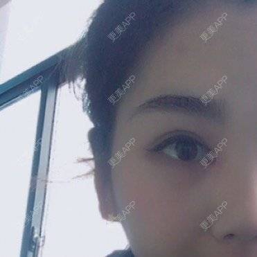 更美 - 谁还不是个宝宝👶的开眼角修复经验 | 常州 | 开眼角修复