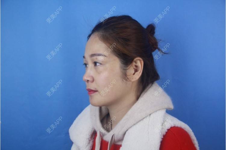 黄褐斑,黄褐斑多少钱_燕燕轻盈黄褐斑多少钱_