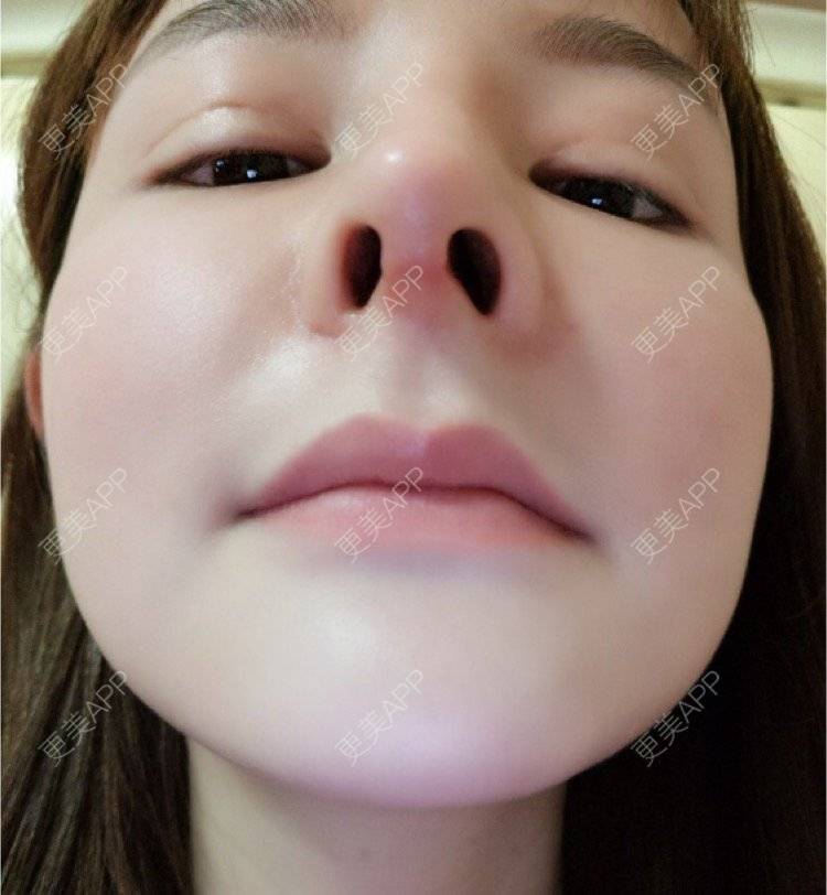 来自非洲的大美妞的硅胶隆鼻日记