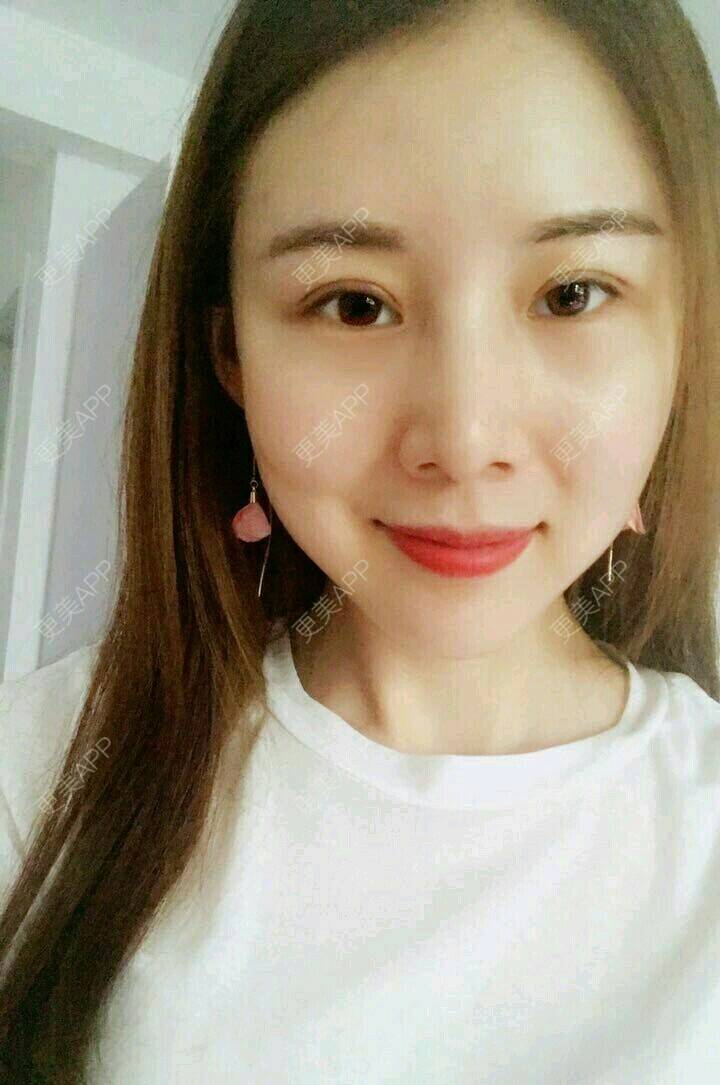 更美 - xNz3B婷的歪鼻矫正经验 | 上海 | 歪鼻矫正