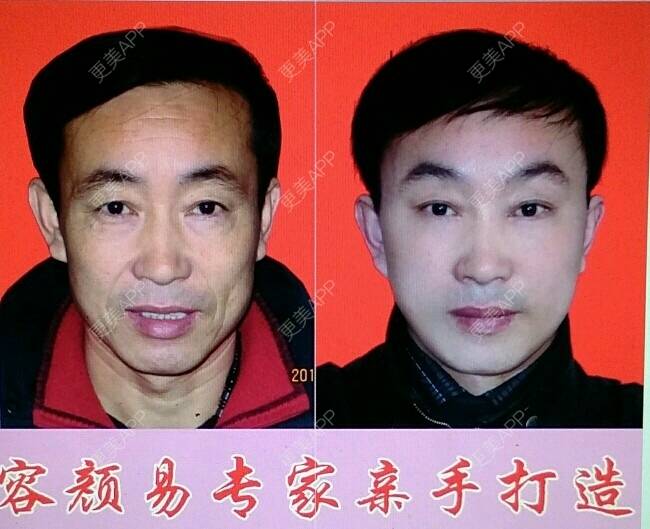 更美 - 更美用户QZb8yFbYuX的拉皮经验 | 拉皮 | 广州