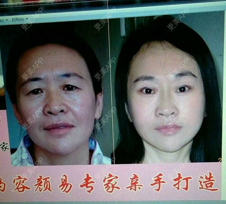 更美 - 更美用户QZb8yFbYuX的拉皮经验 | 拉皮 | 广州